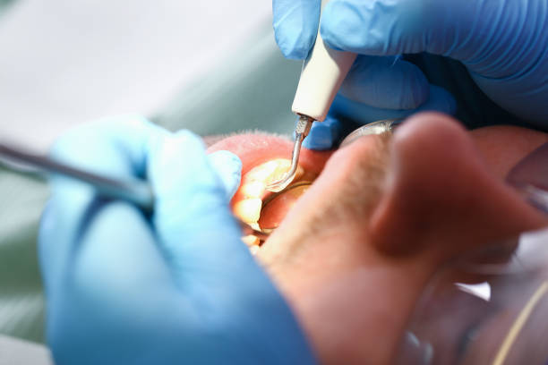 Best Emergency Root Canal Treatment in Boardman, OR