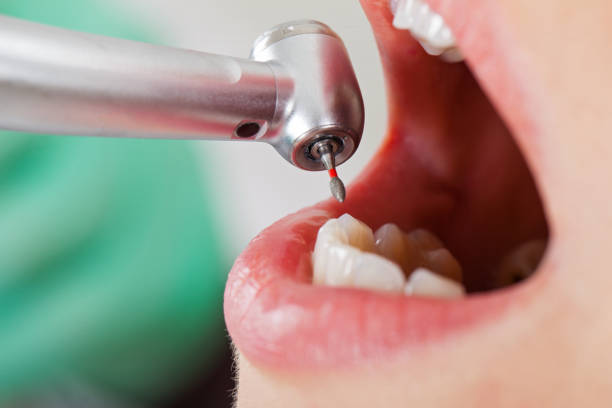 Best Emergency Root Canal Treatment in Boardman, OR